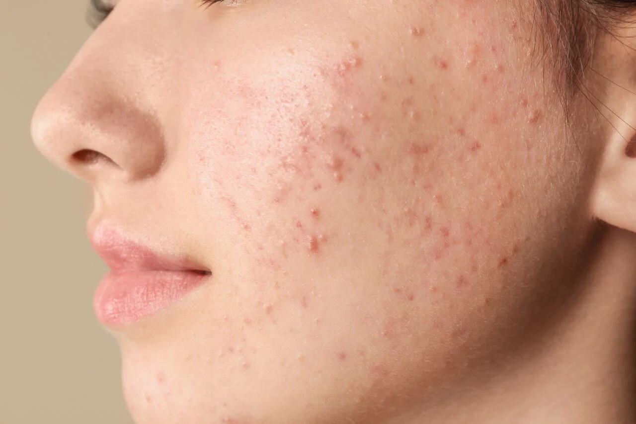 acne-hormonal