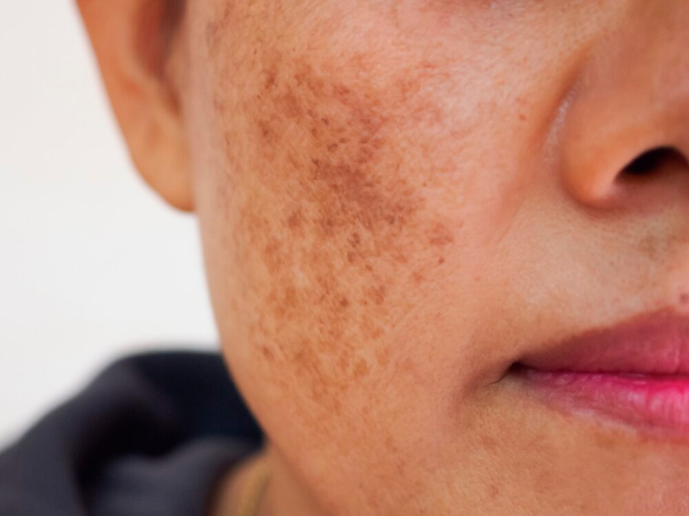 melasma