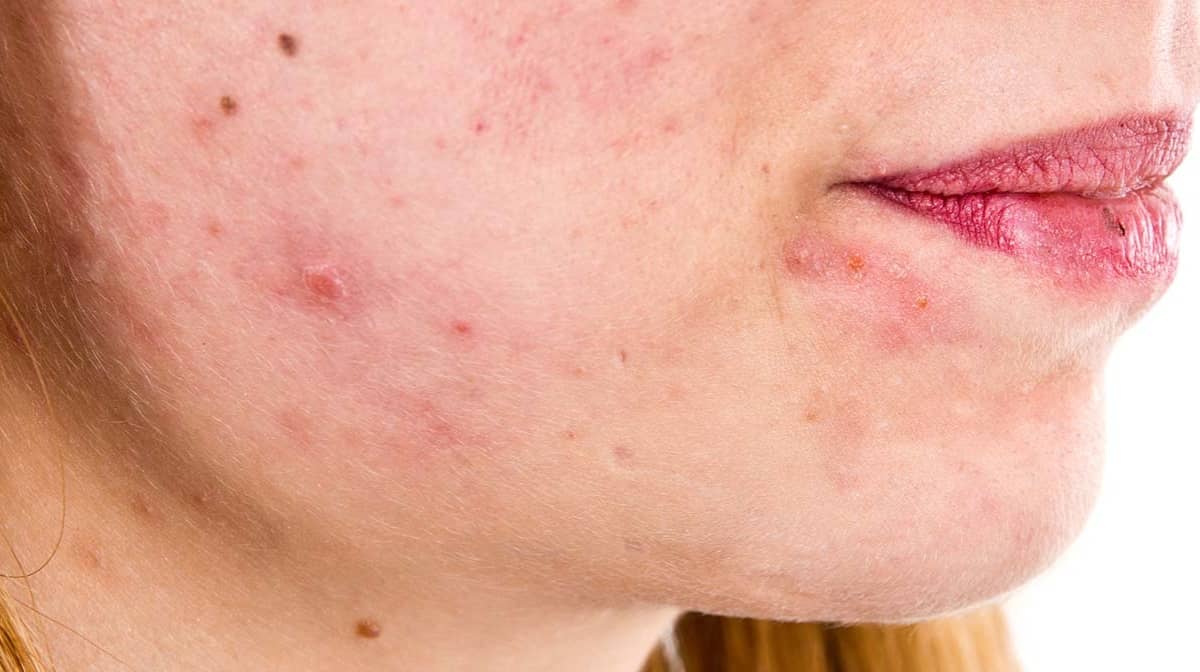 o-que-e-dermatite-seborreica