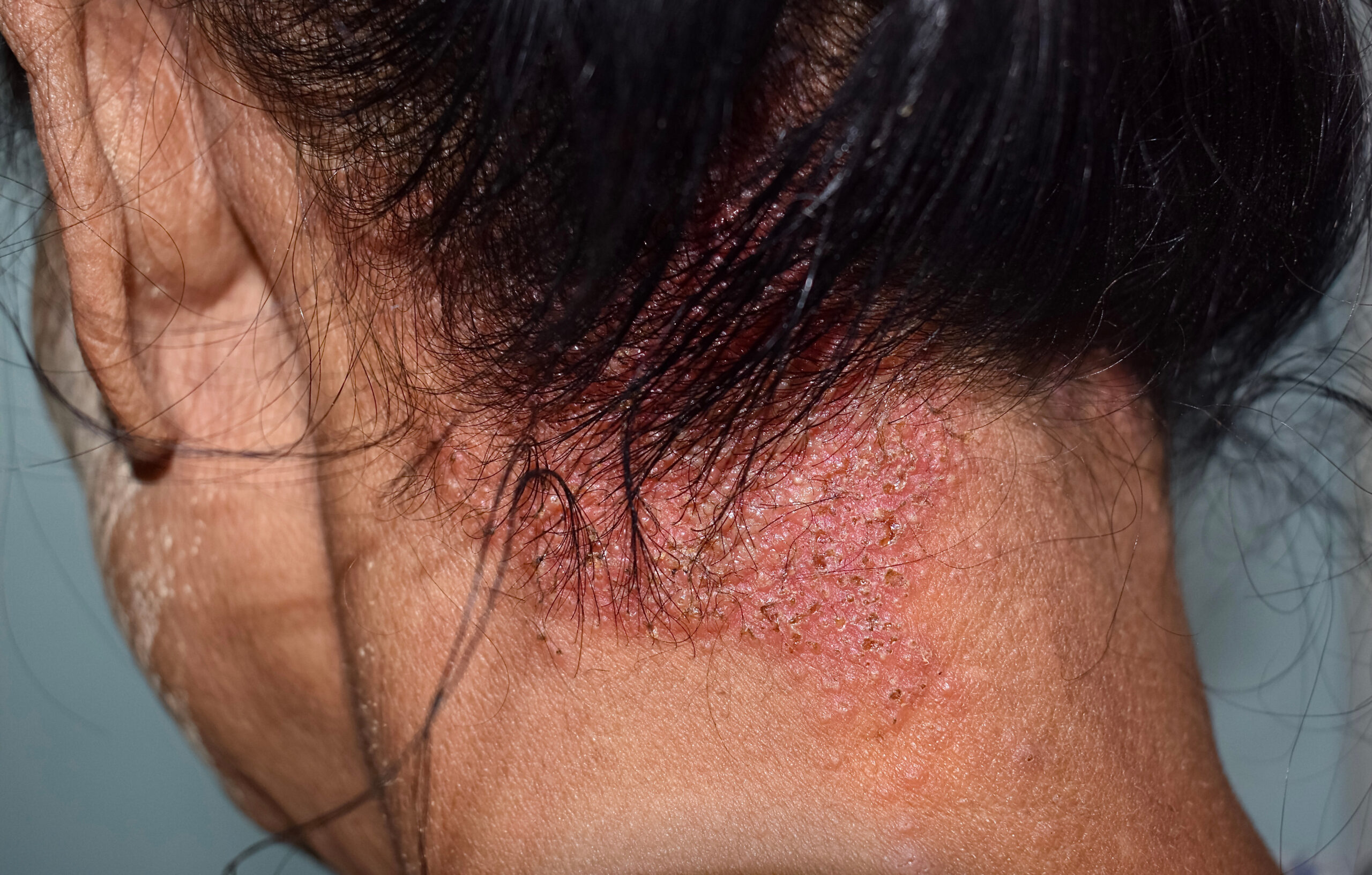psoriase-scaled